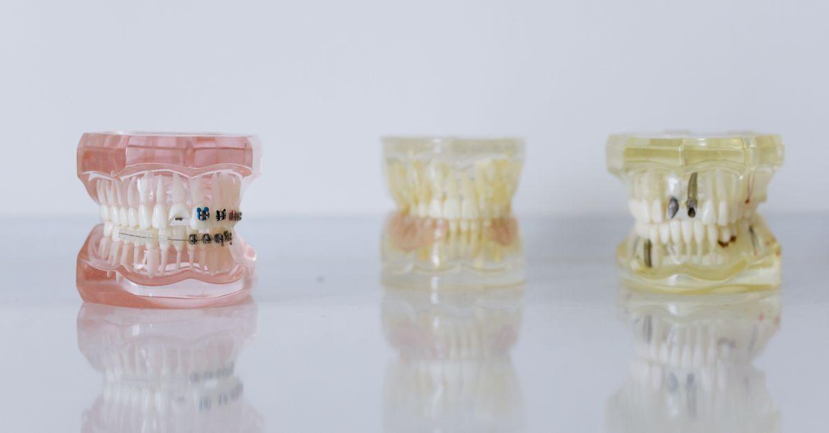 Como escolher o melhor especialista em alinhamento dental na região